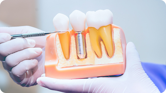 As soluções mais eficazes em implantes dentários, para você sorrir sem dor ou preocupação